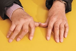 类风湿性关节炎遗传吗?病因是什么 类风湿性关节炎遗传吗?病因是什么